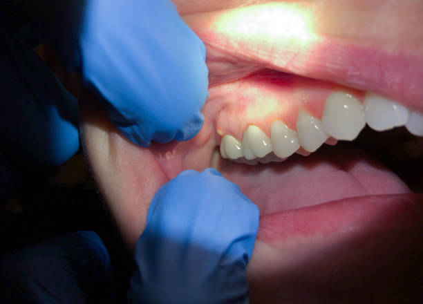 Best Emergency Treatment for Oral Infections in Premont, TX